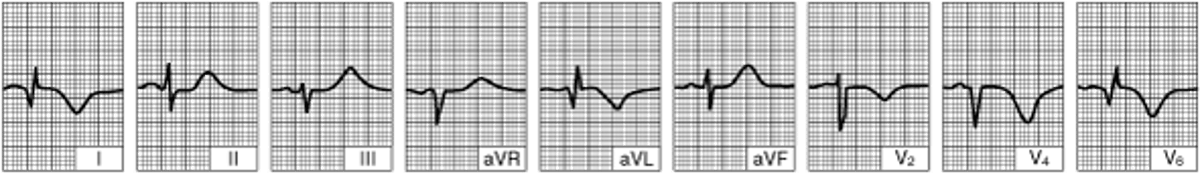 ИМ боковой стенки левого желудочка (через несколько суток с момента развития заболевания)