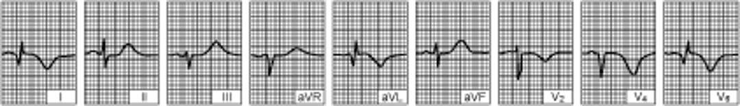 Nhồi máu cơ tim thành bên thất trái (vài ngày sau đó)