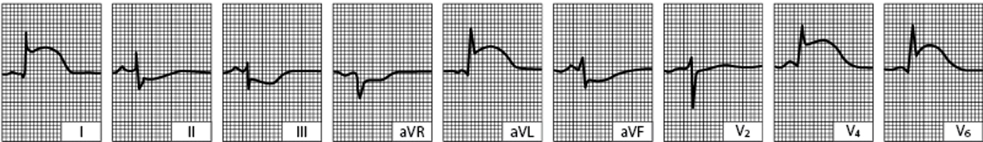 Infarctus latéral aigu du ventricule gauche (tracé obtenu quelques heures après le début de la maladie)