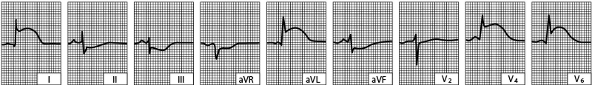Infarto agudo lateral do ventrículo esquerdo (traçado obtido poucas horas após o início da doença)