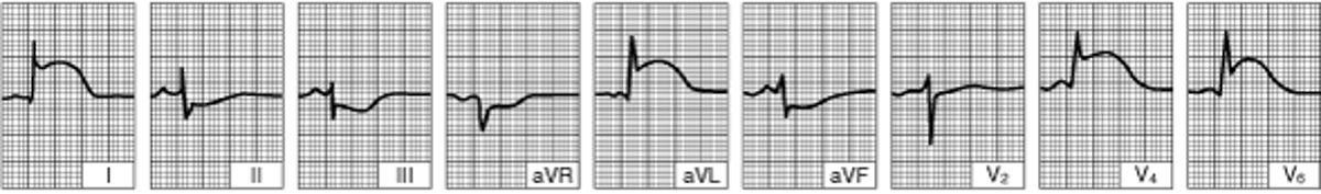 Острый боковой инфаркт левого желудочка (ЭКГ проведена в течение нескольких часов после начала заболевания)