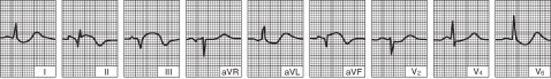 Inferior (Diaphragmatic) Left Ventricular Infarction (after the first 24 hours)