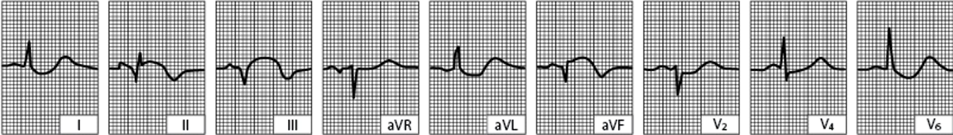 Infarctus du myocarde inféropostérieur (diaphragmatique) (après les 24 premières heures)