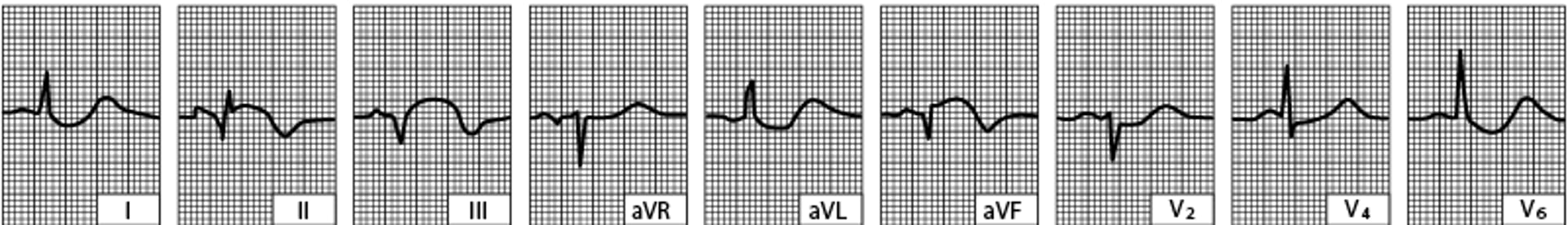 Infarto ventricular esquerdo (diafragmático) inferior (após as primeiras 24 horas)