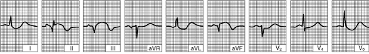 Инфаркт нижнего (диафрагмального) левого желудочка (после первых 24 часов).