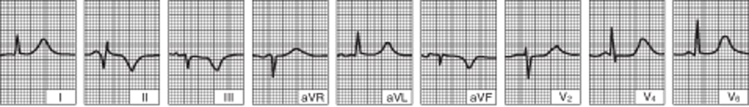 Inferior (Diaphragmatic) Left Ventricular Infarction (several days later)