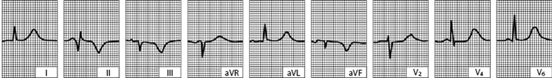 Infarctus du myocarde inféropostérieur (diaphragmatique) (plusieurs jours plus tard)