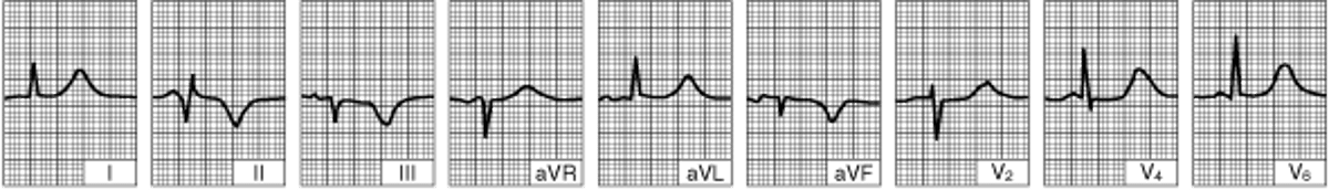 Нижний инфаркт (диафрагмальный) левого желудочка (несколько суток с момента развития заболевания)