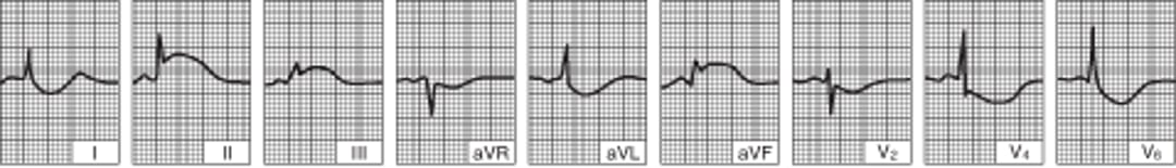 Acute Inferior (Diaphragmatic) Left Ventricular Infarction (tracing obtained within a few hours of onset of illness)