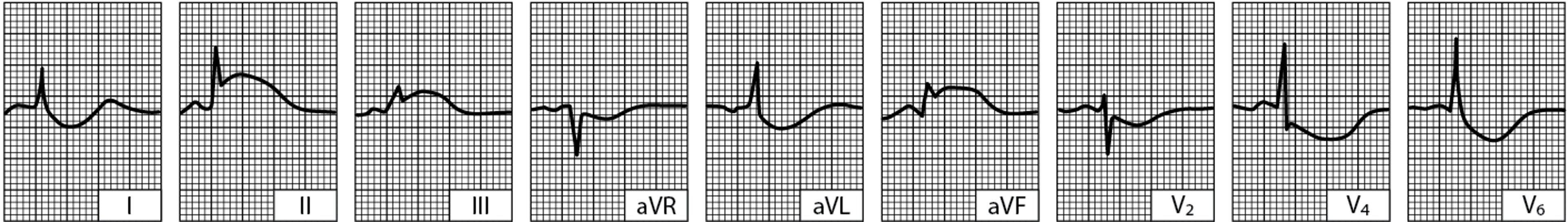 Akuter inferiorer (Zwerchfell) LV-Infarkt (Tracing innerhalb weniger Stunden nach Auftreten der Krankheit erhoben)