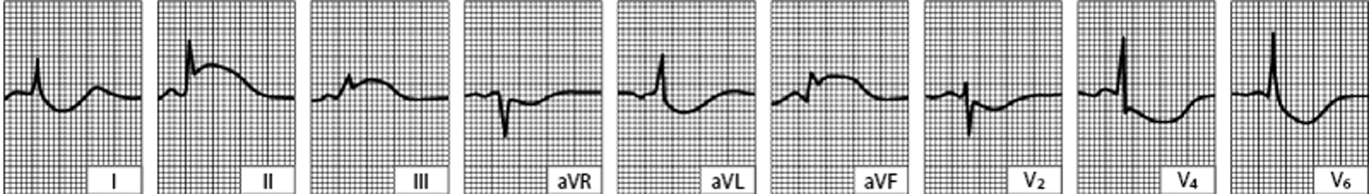 Infarctus du myocarde aigu inféropostérieur (diaphragmatique) (tracé obtenu quelques heures après le début de la douleur)