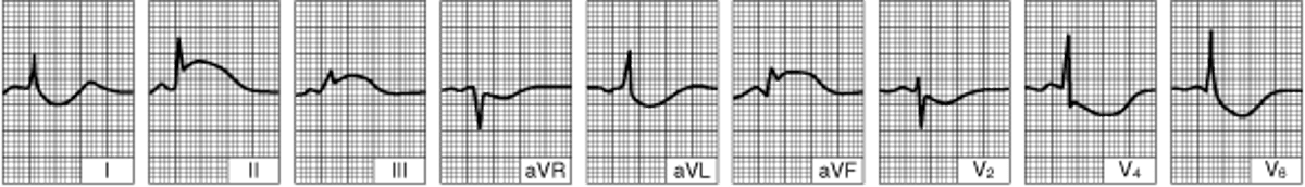 Нижний ИМ (диафрагмальный) левого желудочка (отслеживание, в течение нескольких часов после начала болезни)