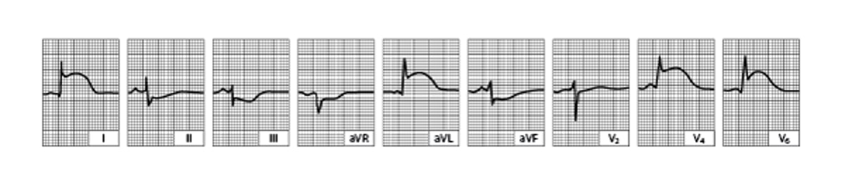 Acute Lateral Left Ventricular Infarction (tracing obtained within a few hours of onset of illness)