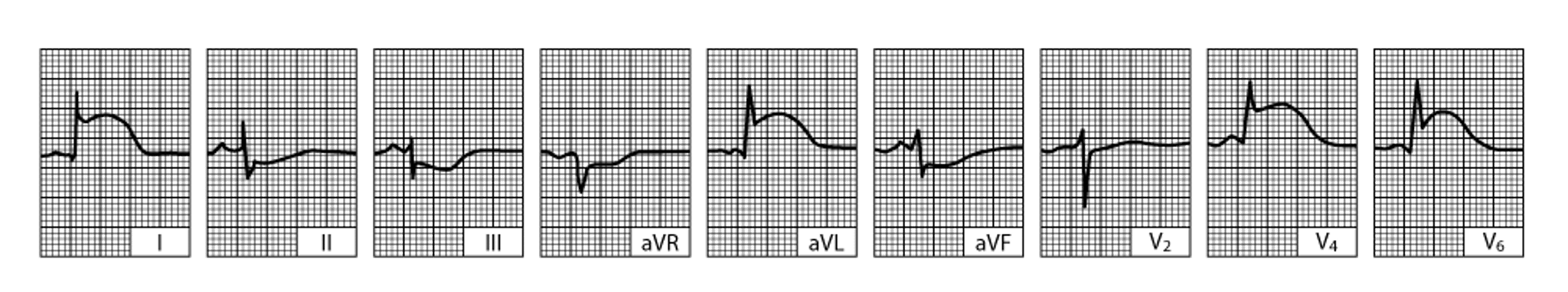Acute Lateral Left Ventricular Infarction (tracing obtained within a few hours of onset of illness)