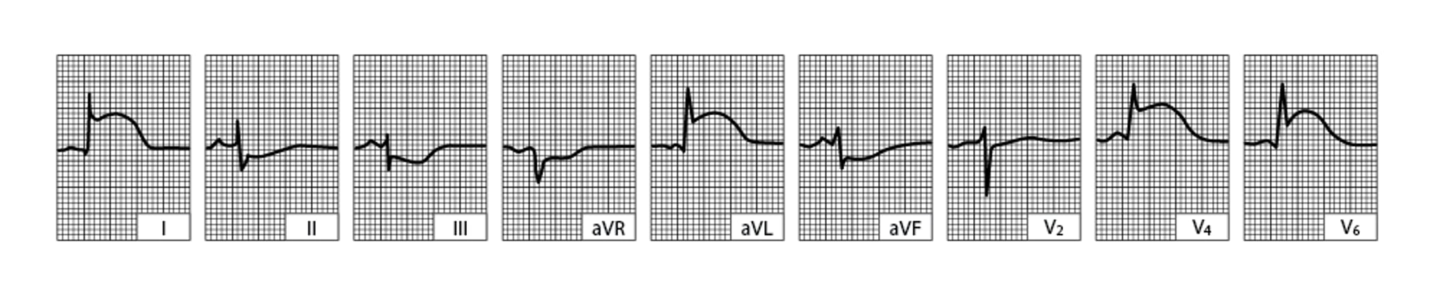 Infarctus latéral aigu du ventricule gauche (tracé obtenu quelques heures après le début de la maladie)