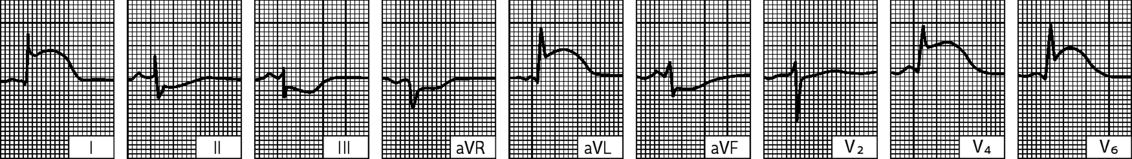 Nhồi máu cấp tính thành bên thất trái (theo dõi được trong vòng vài giờ sau khi phát bệnh)