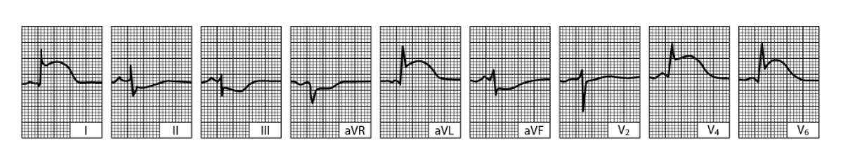急性左室侧壁心肌梗死（发病数小时内记录）