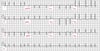 Atrial Fibrillation