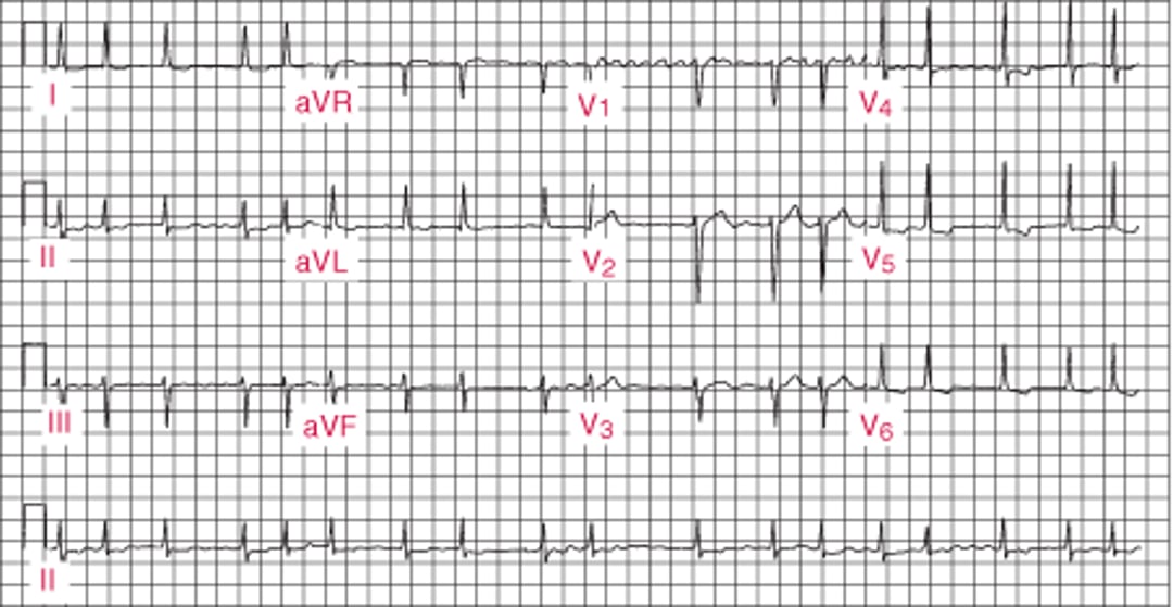 Atrial Fibrillation