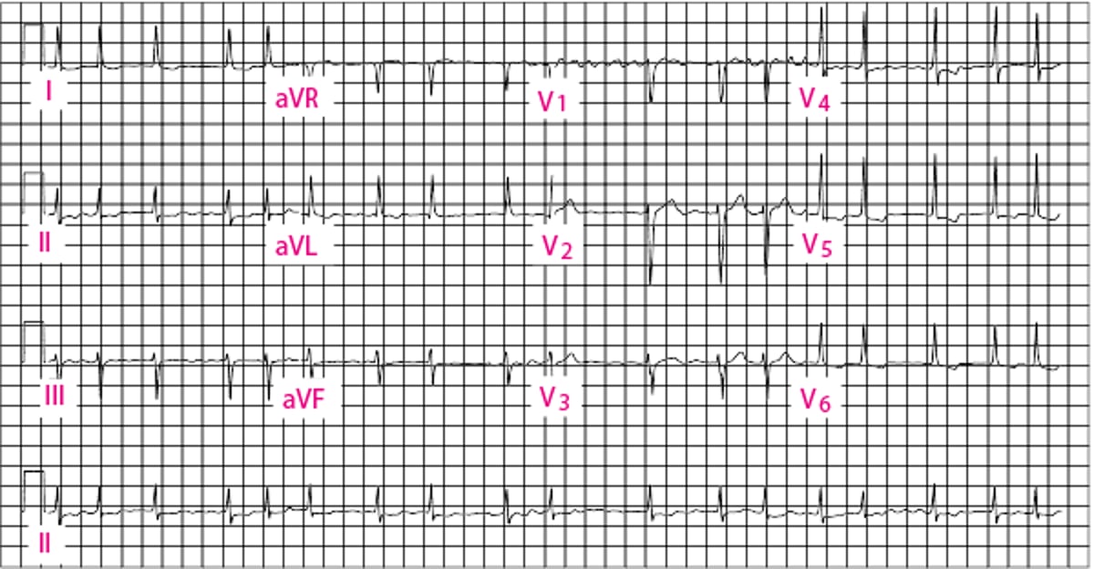 Fibrilação atrial