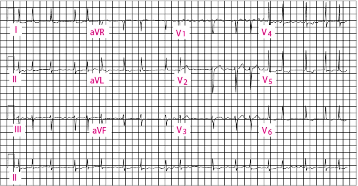 Fibrilação atrial