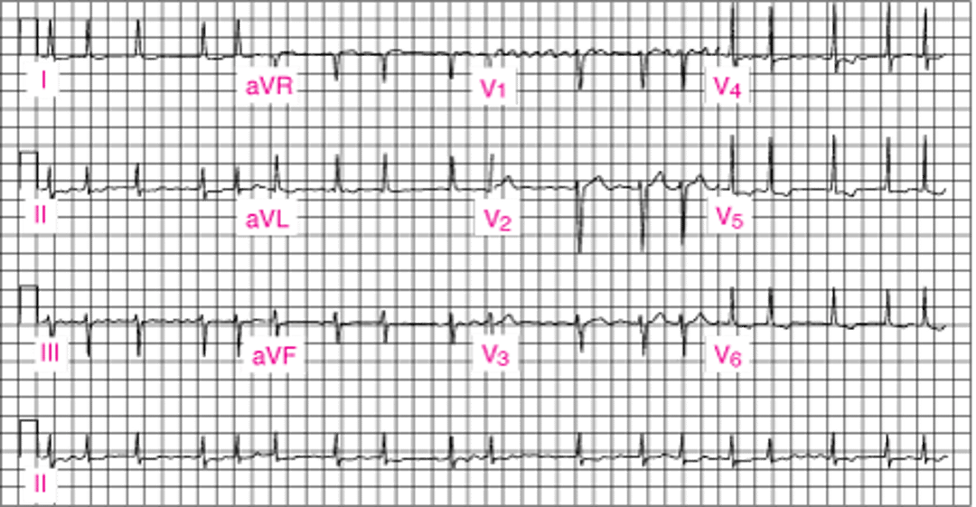 Фибрилляция предсердий