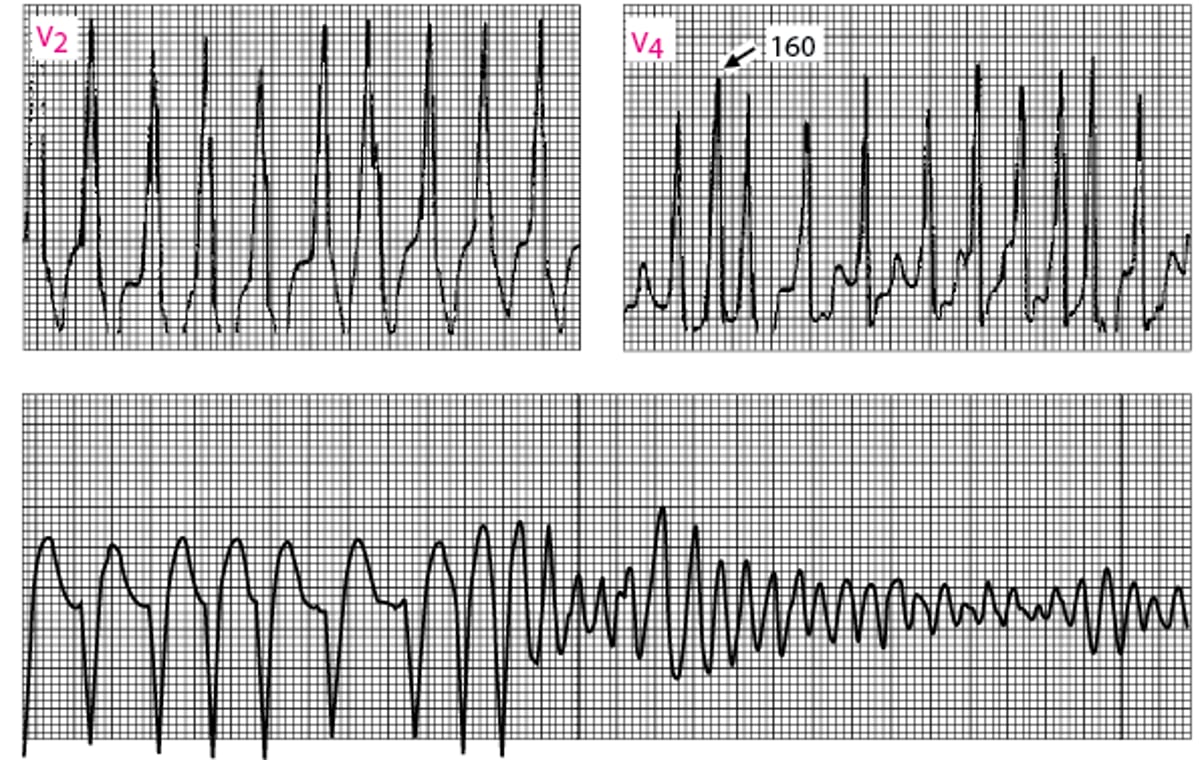 Atrial Fibrillation in Wolff-Parkinson-White Syndrome