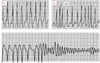 Fibrilación auricular en el síndrome de Wolff-Parkinson-White