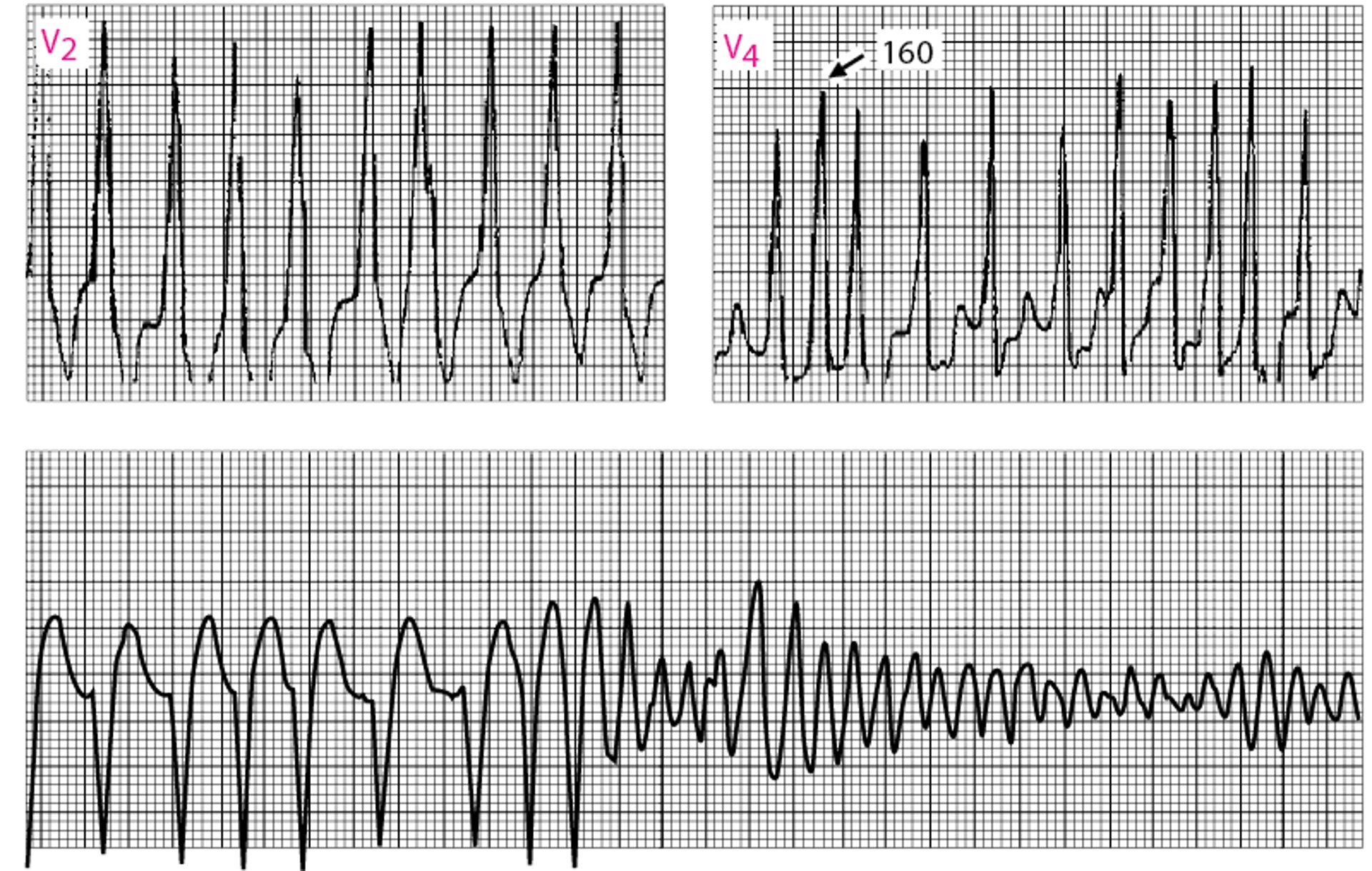 Fibrilación auricular en el síndrome de Wolff-Parkinson-White