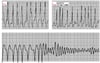 Fibrilação atrial na síndrome de Wolff-Parkinson-White