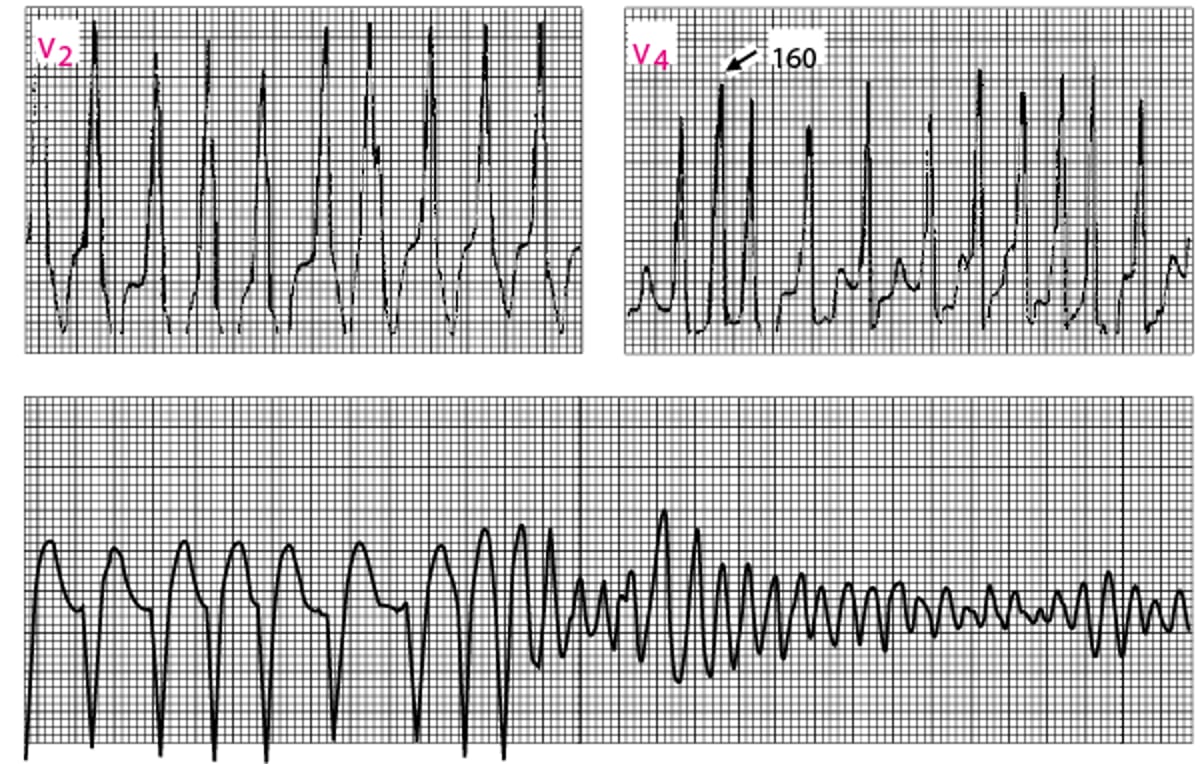 Fibrilação atrial na síndrome de Wolff-Parkinson-White