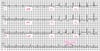 Atrial Flutter