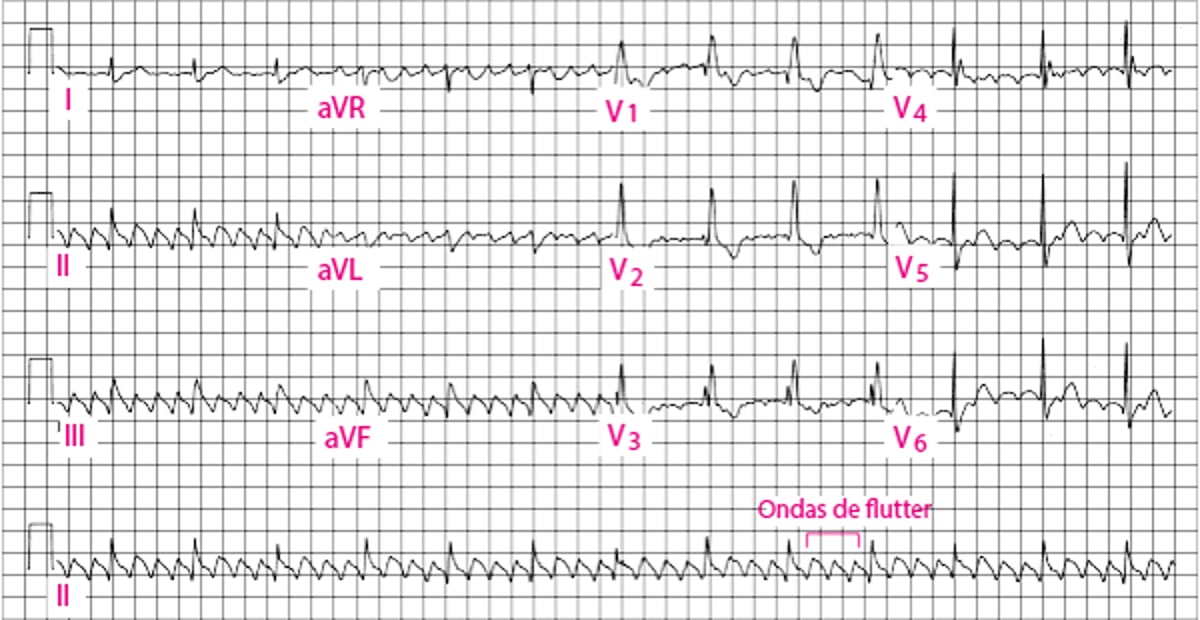 Flutter atrial