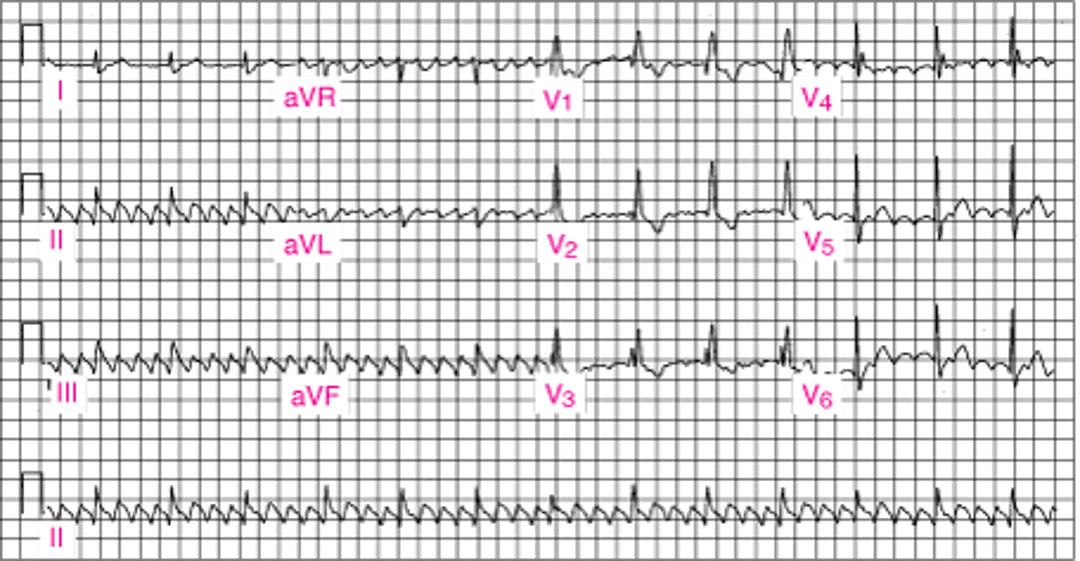 Трепетание предсердий