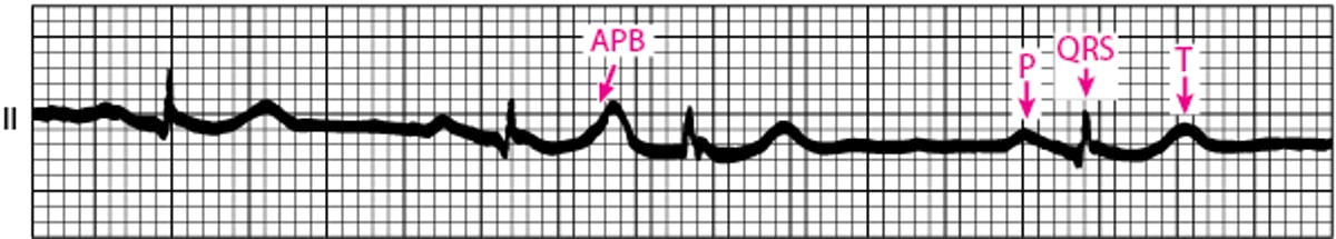 Atrial Premature Beat (APB)