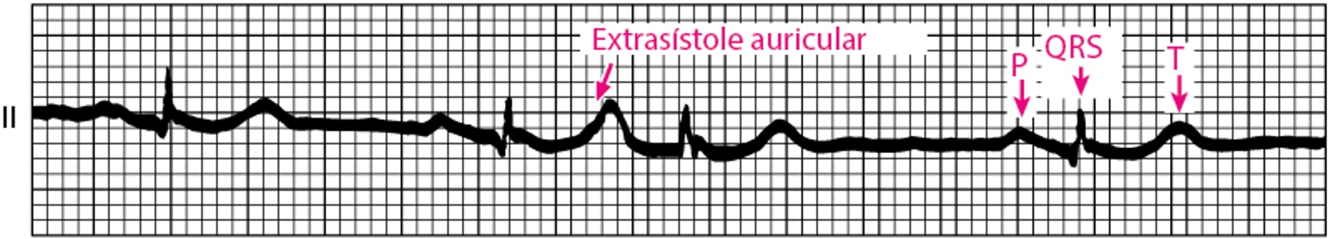 Extrasístole auricular