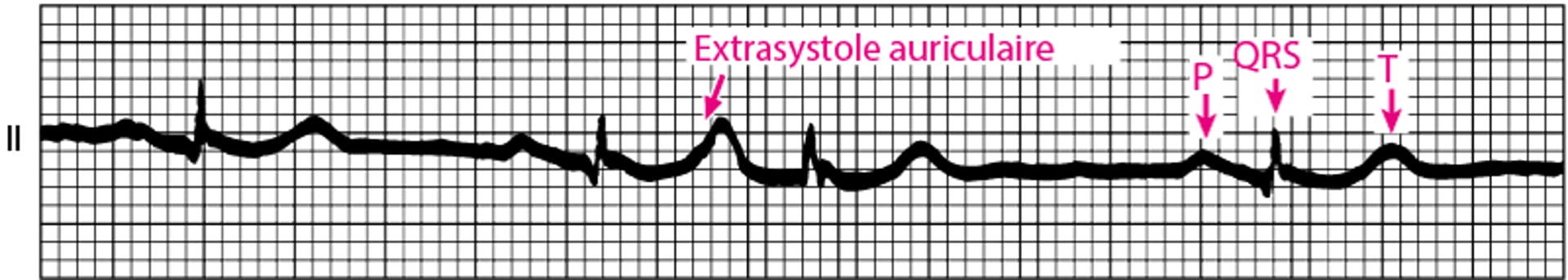 Extrasystoles auriculaires