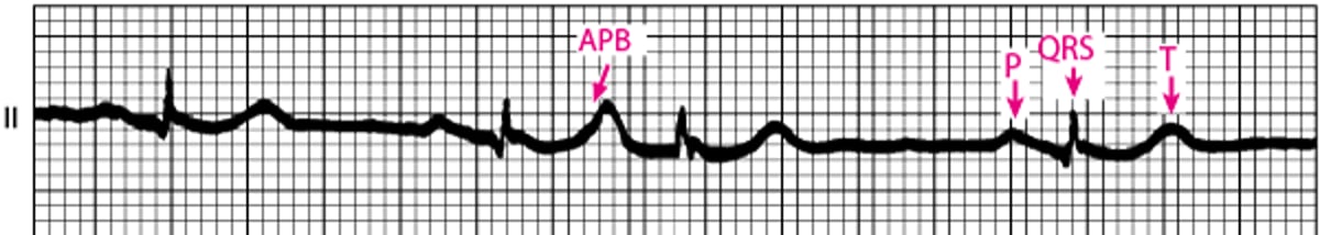 Extrassístoles supraventriculares (ESSVs)