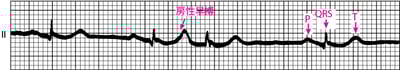 房性早搏（APB）