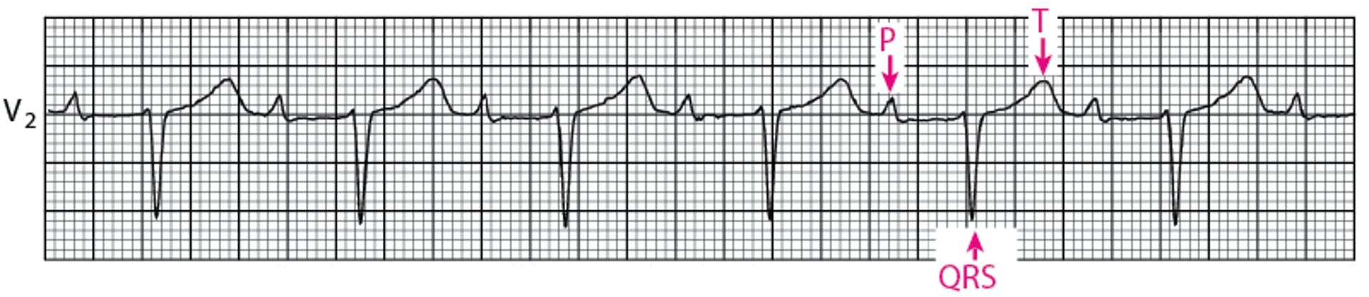 Bloqueo auriculoventricular de primer grado