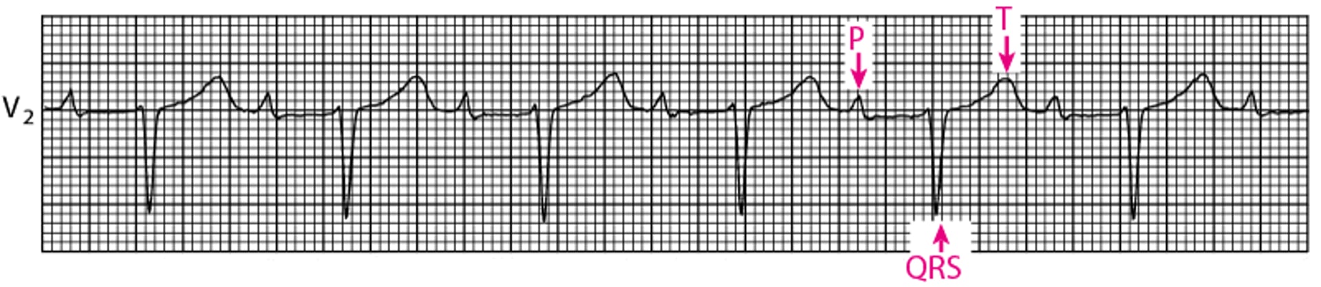 Bloc auriculoventriculaire du premier degré