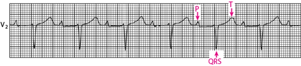 Bloqueio atrioventricular de primeiro grau