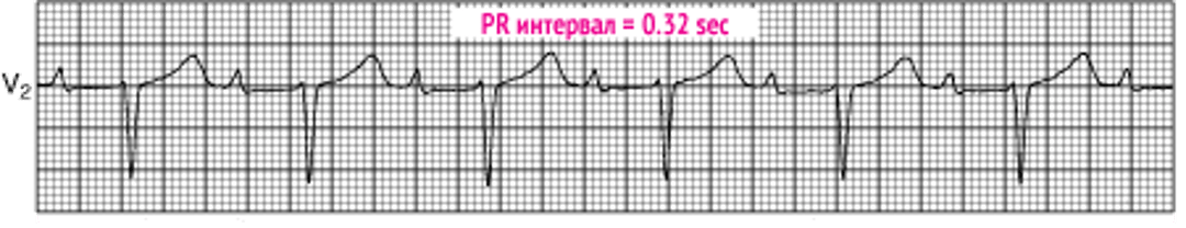 Атриовентрикулярная блокада 1 степени