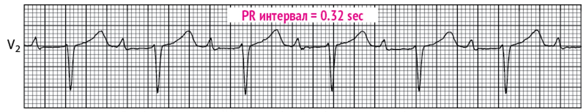 Атриовентрикулярная блокада 1 степени