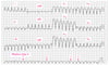 Broad QRS Ventricular Tachycardia