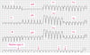 Ventrikuläre Tachykardie mit breitem QRS-Komplex