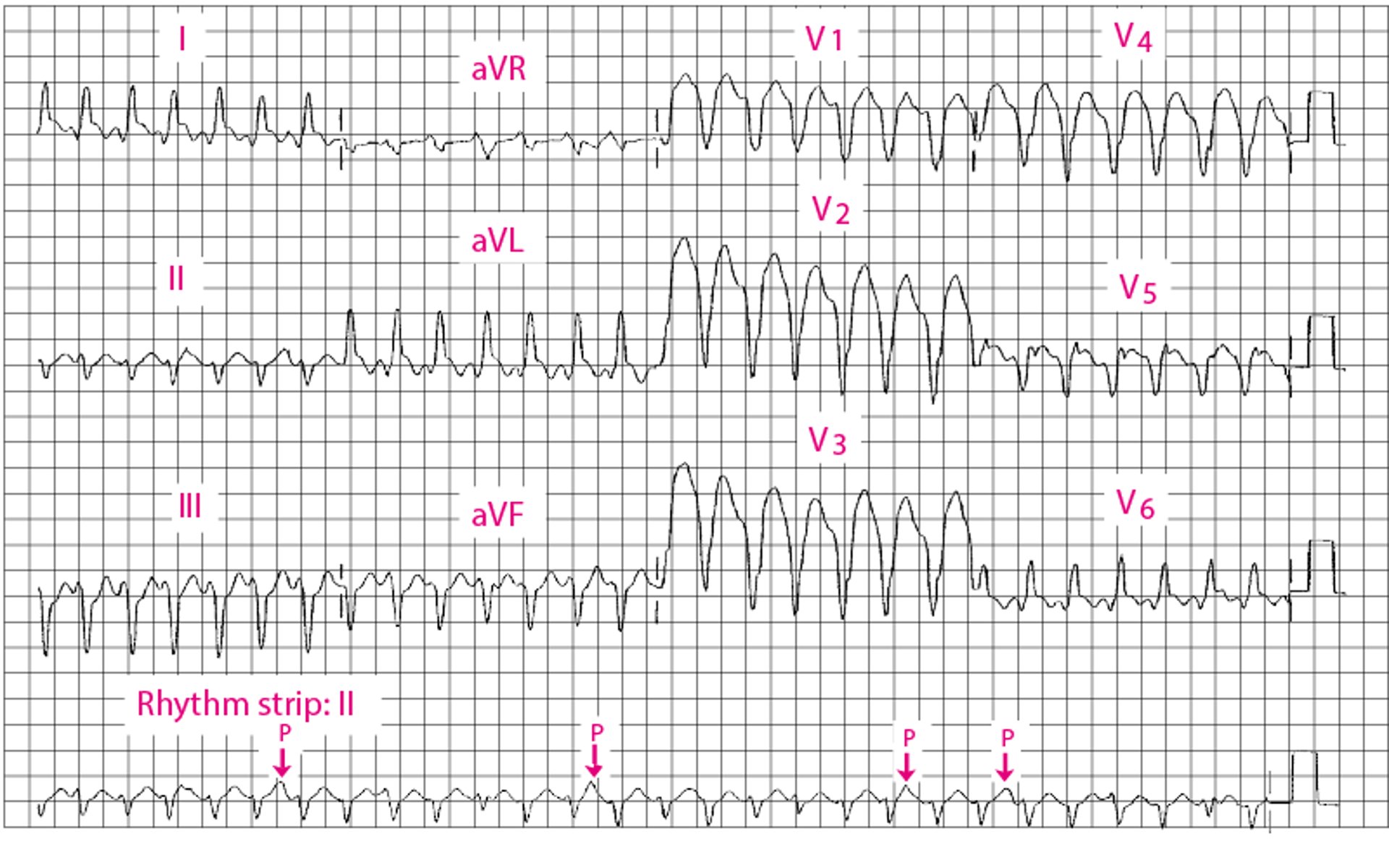 Ventrikuläre Tachykardie mit breitem QRS-Komplex