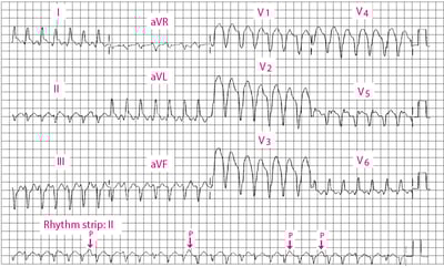 Ventrikuläre Tachykardie mit breitem QRS-Komplex