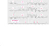 Taquicardia ventricular con complejo QRS ancho