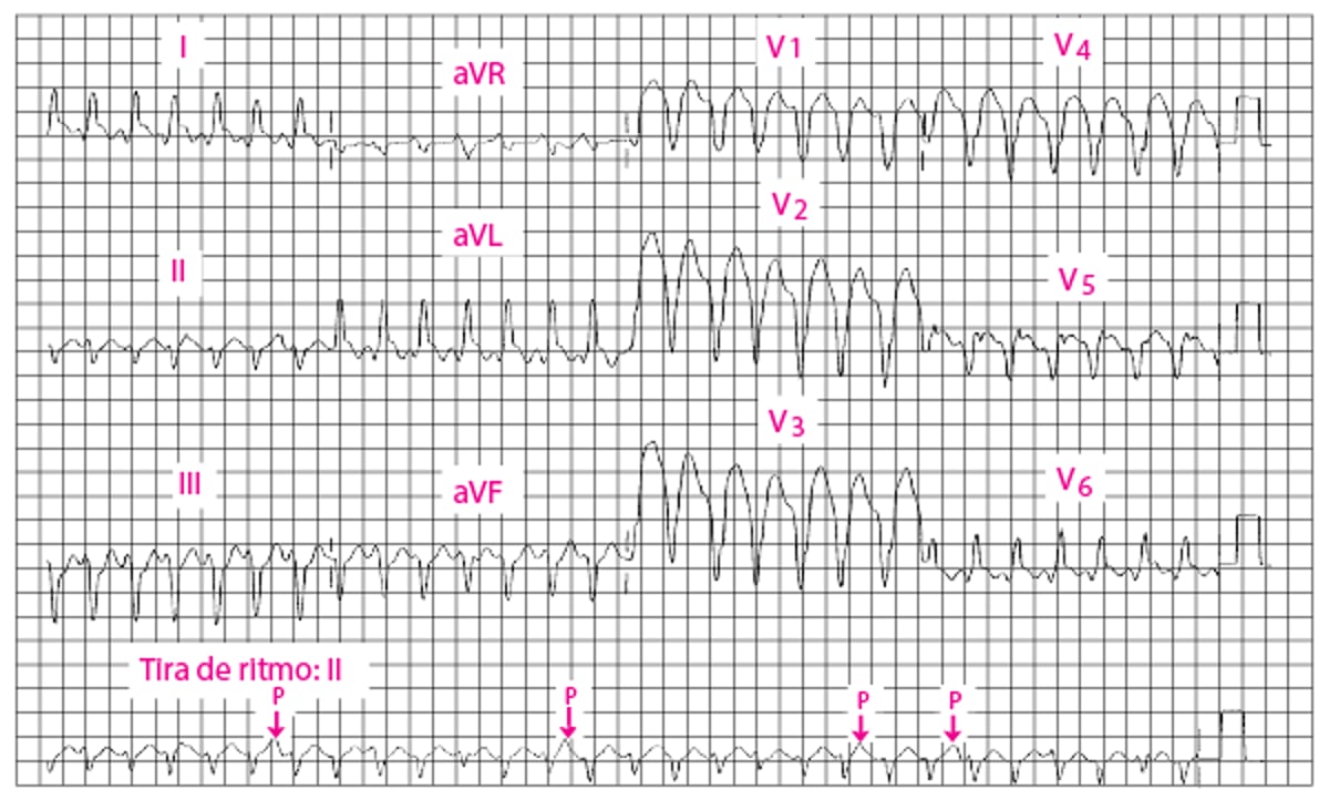 Taquicardia ventricular con complejo QRS ancho